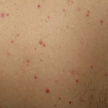 Shelburn Male Teen's Rash on Back