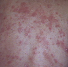 Winooski Man's Rash on Back